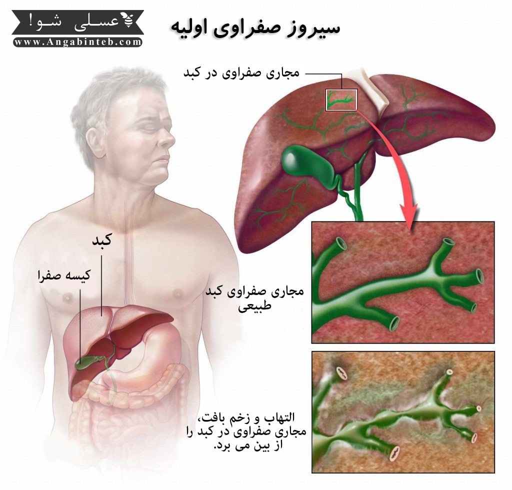  سیروز صفراوی اولیه